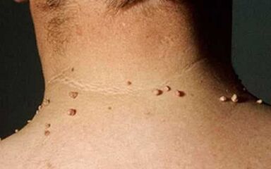 Causes of the appearance of papilloms