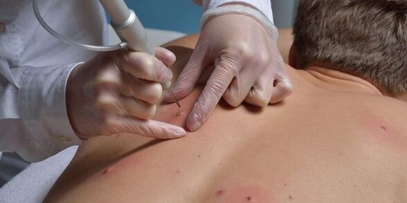 Removing papiles