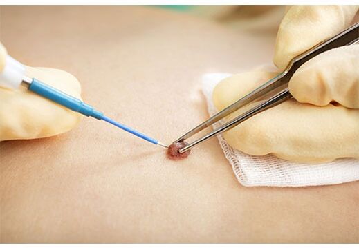 Removing papiles