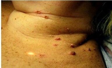 Photos of many papilloma in women