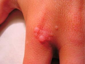 How to get rid of small papillom
