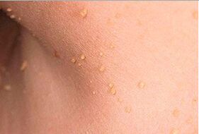What do the papiles in the body look like