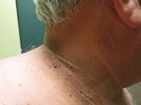 Causes of the appearance of the cluster of the papiles in the body