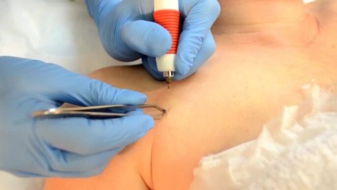 Electrococoagulation - a method for the removal of papiles