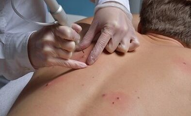 Ways to remove papillomas