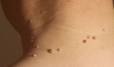 causes of papillomas