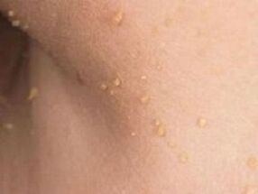 causes of the appearance of papillomas on the body