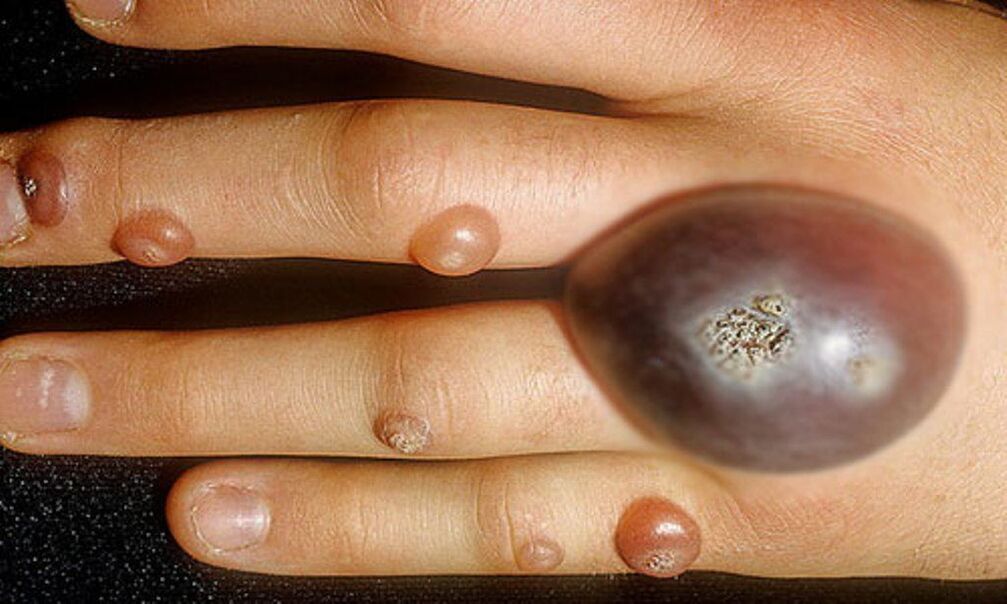 big warts on hand
