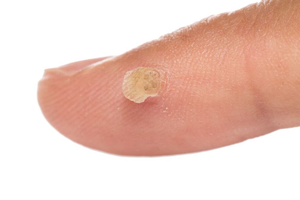 genital wart on the finger
