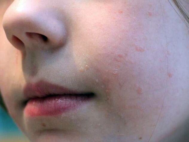 Flat warts on the face appear most often during adolescence